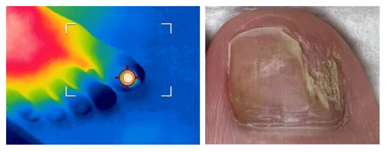 Onychomycosis Fungal Nail